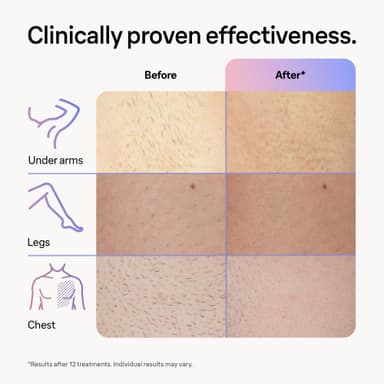 Braun Smart IPL Skin i-Expert Pro 7 valoimpulssilaite PL7249