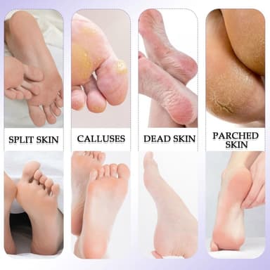 10 kpl/setti Jalkahoito Pedikyyri Callus Dead Skin Remover Jalkaviila Kovettumisen poisto